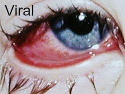 Conjunctivitis Viral A